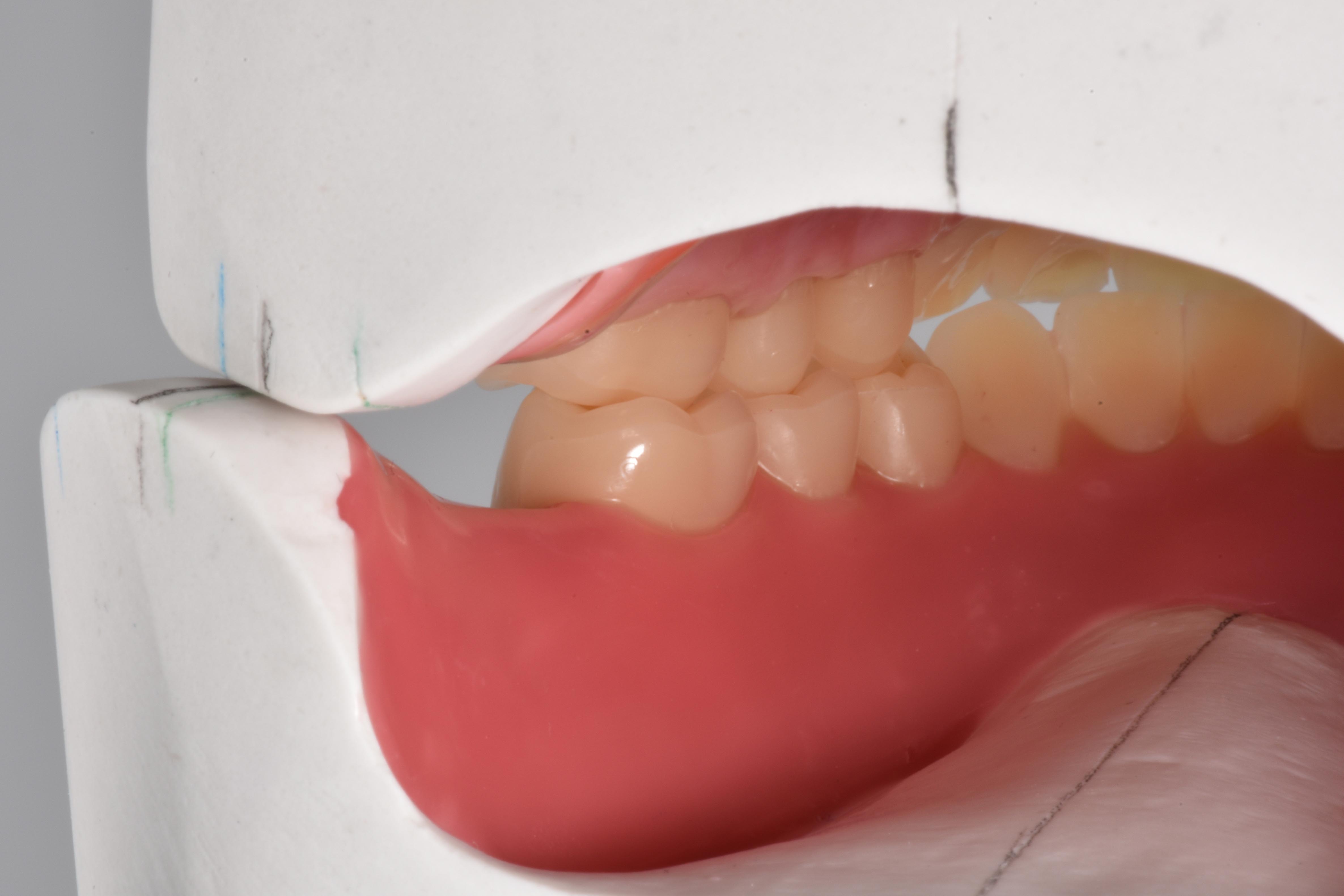 Full dentures at the highest esthetic level - CANDULOR AG